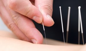 acupuncture