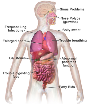 Cystic Fibrosis