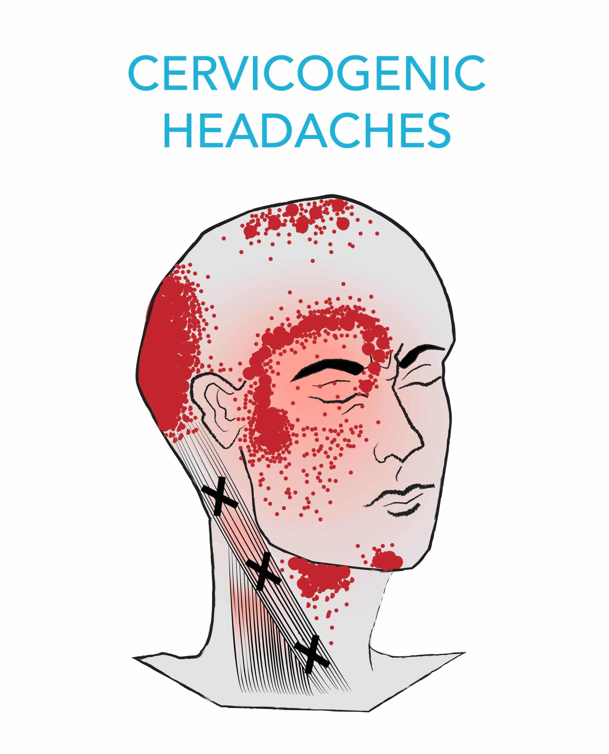 Health & Meditation: Cervicogenic Headaches